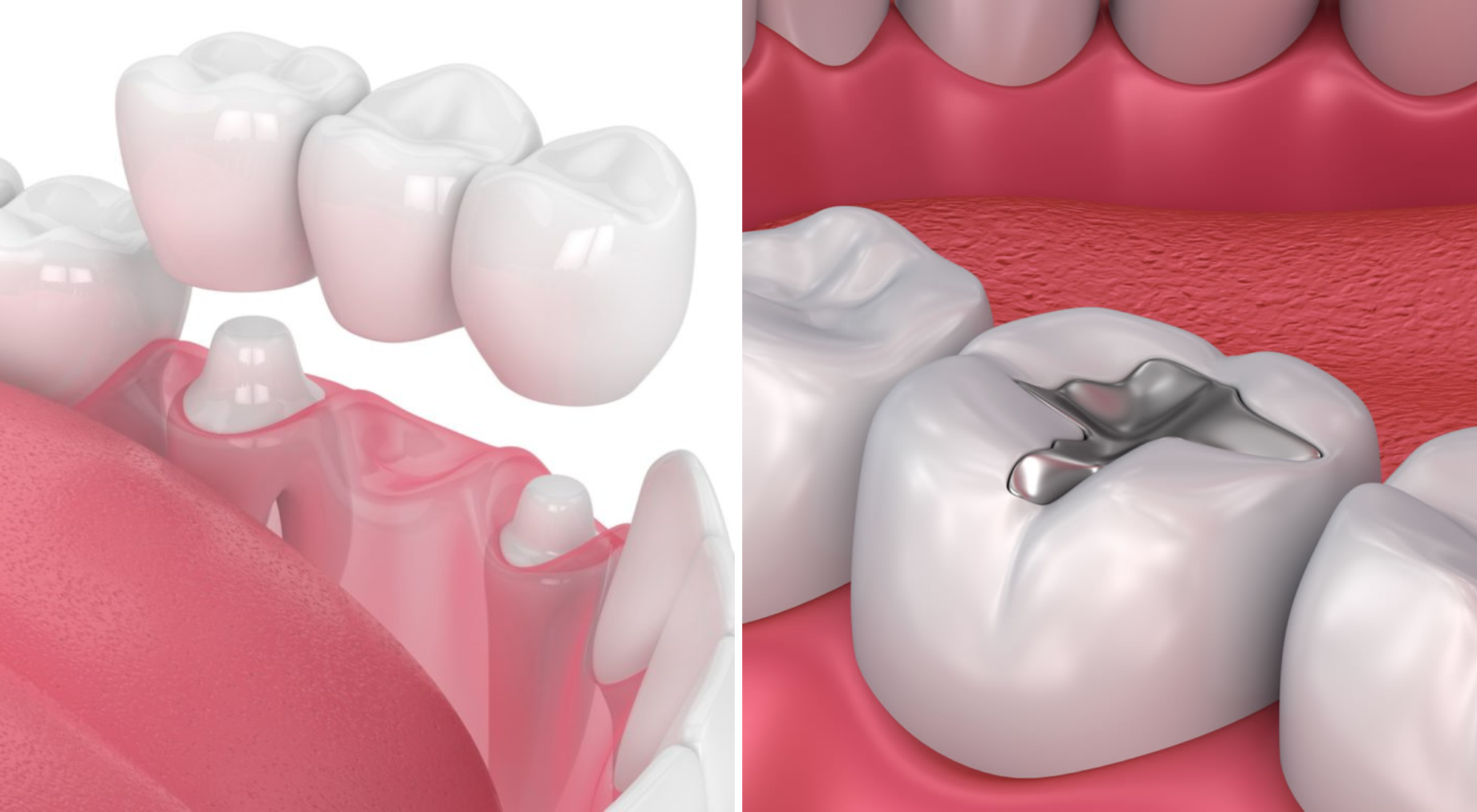 crowns vs fillings