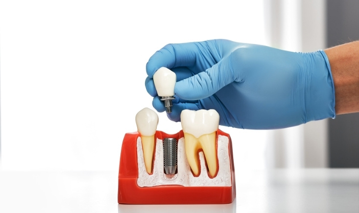 the hidden risks of delaying dental implants