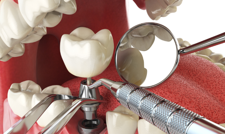 What Happens After Getting Dental Implants: A Recovery Timeline