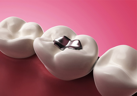 composite fillings last longer