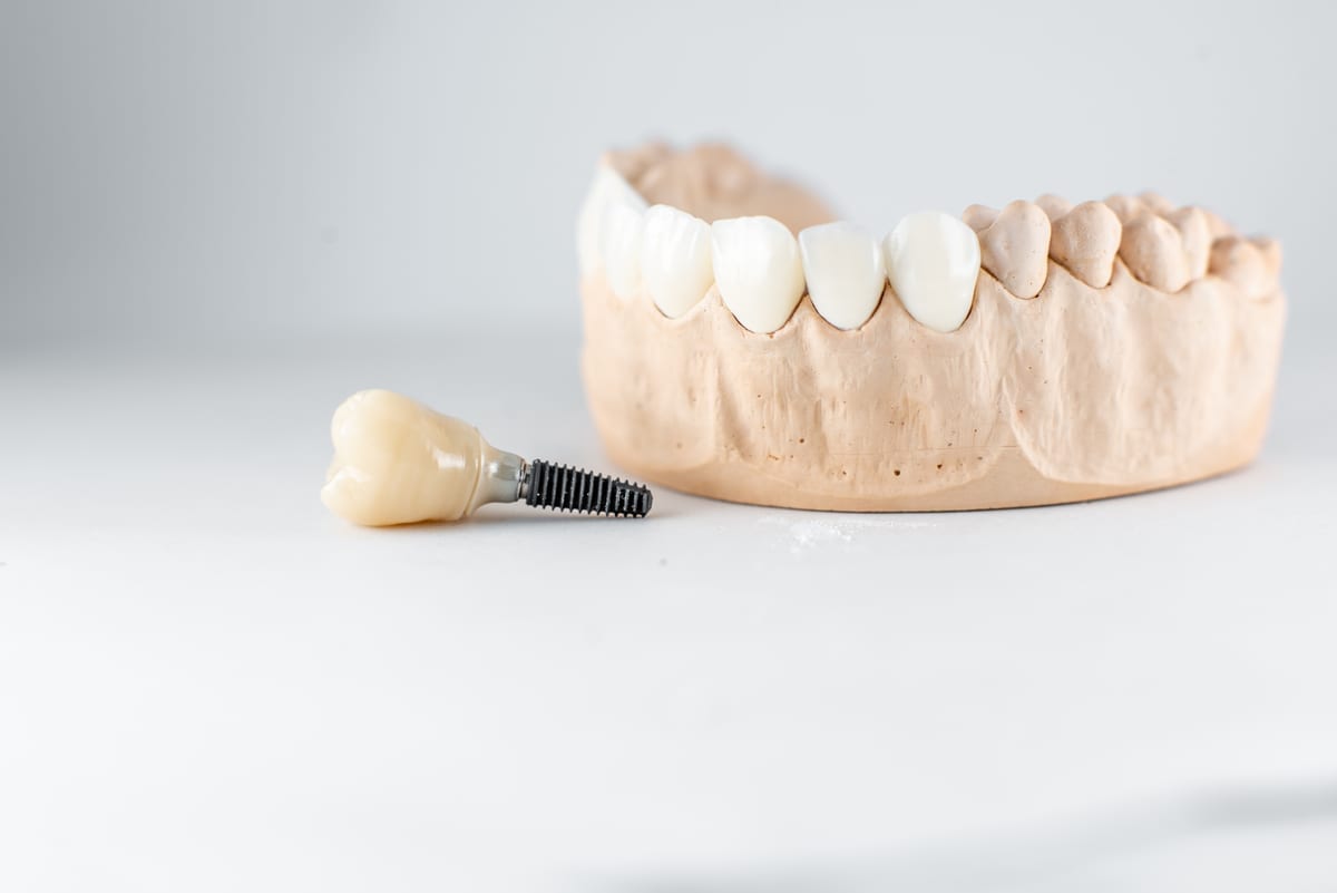 Dental Implants in Denville